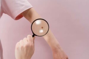 India’s rare disease policy